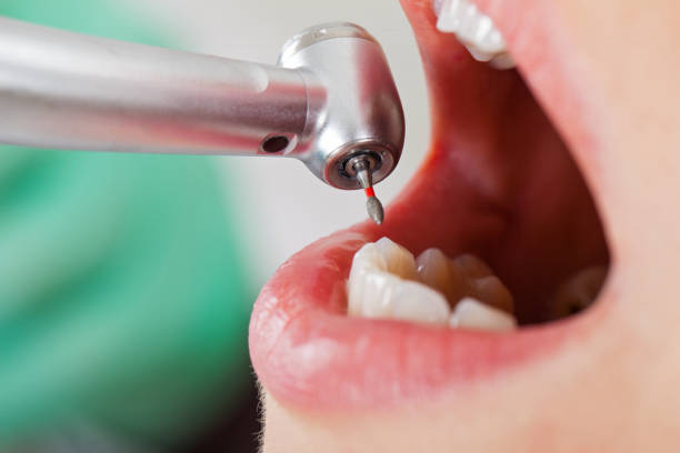 Best Emergency Root Canal Treatment in Marshall, IL